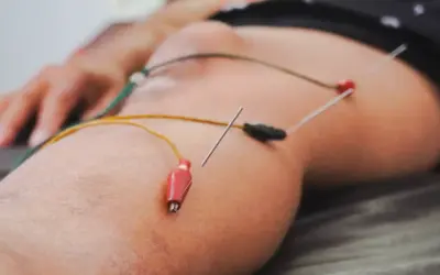 How Dry Needling Complements Physical Therapy for Injury Rehabilitation