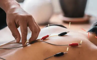 Dry Needling vs. Acupuncture: What’s the Difference?
